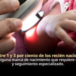 Marcas de nacimiento requieren valoración médica para identificar riesgos y brindar tratamiento adecuado